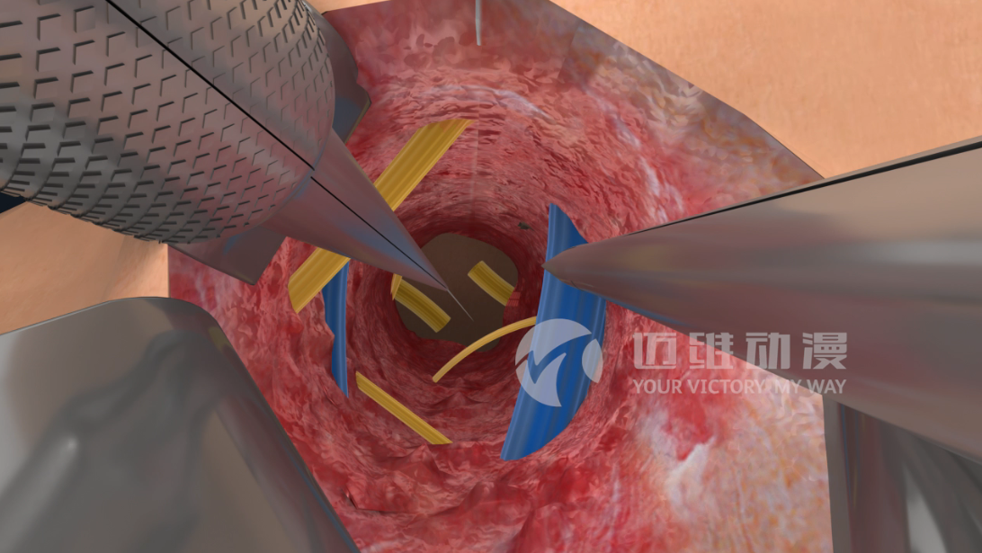 醫(yī)學(xué)手術(shù)三維動(dòng)畫 醫(yī)學(xué)手術(shù)三維動(dòng)畫
