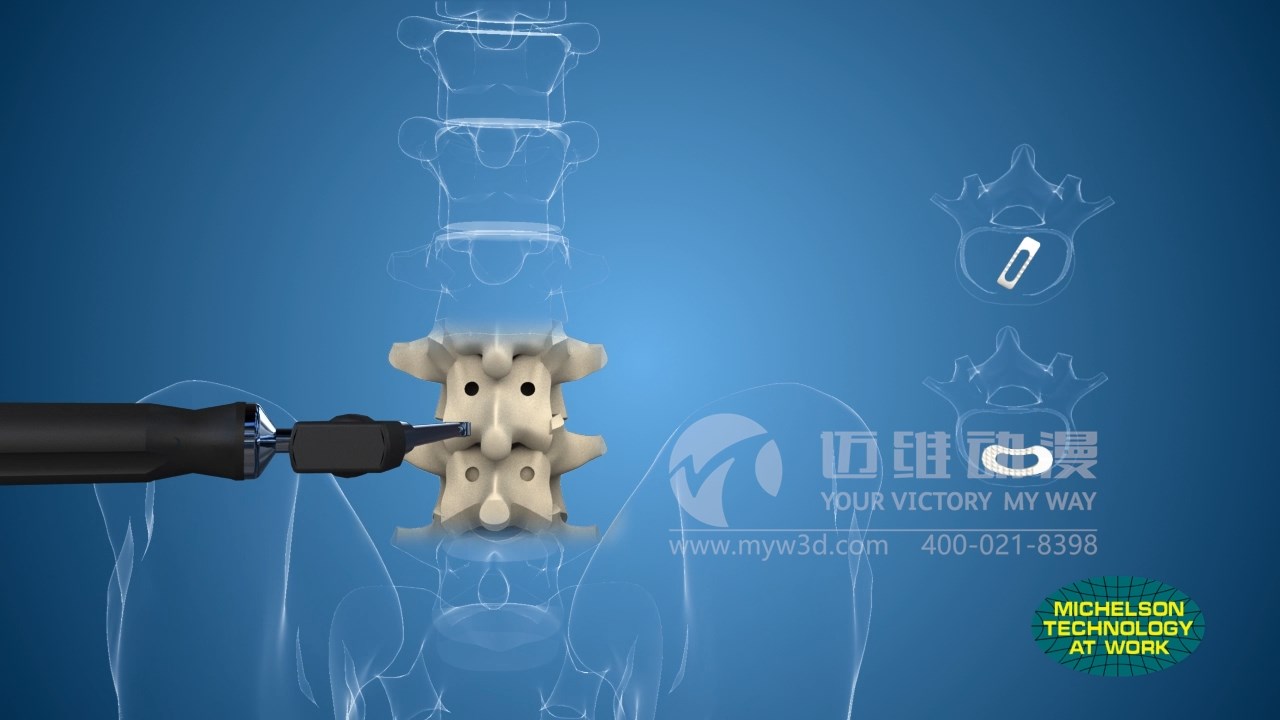 醫(yī)療三維動(dòng)畫制作.jpg 醫(yī)療三維動(dòng)畫制作.jpg