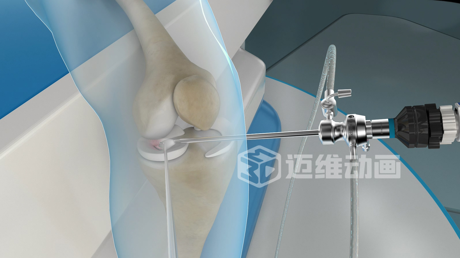 關(guān)節(jié)鏡手術(shù)三維動畫 關(guān)節(jié)鏡手術(shù)三維動畫